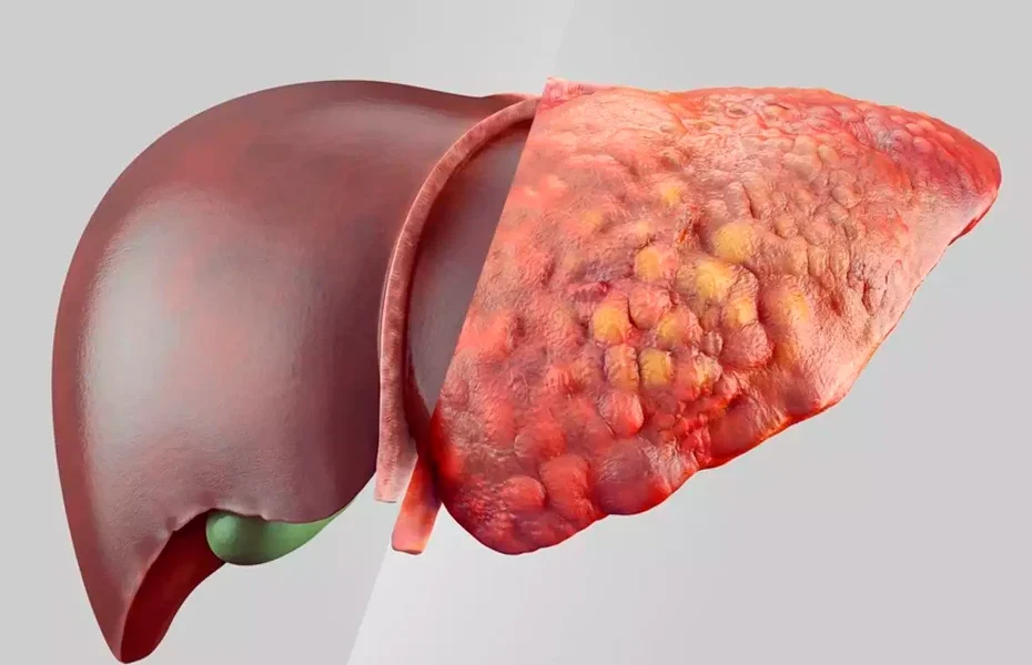 gordura no fígado sintomas